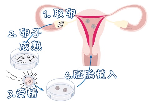 PGT三代试管
